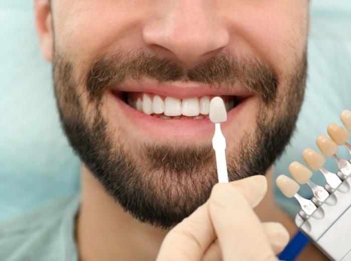 3 Signs It Might Be Time to Replace Your Veneers