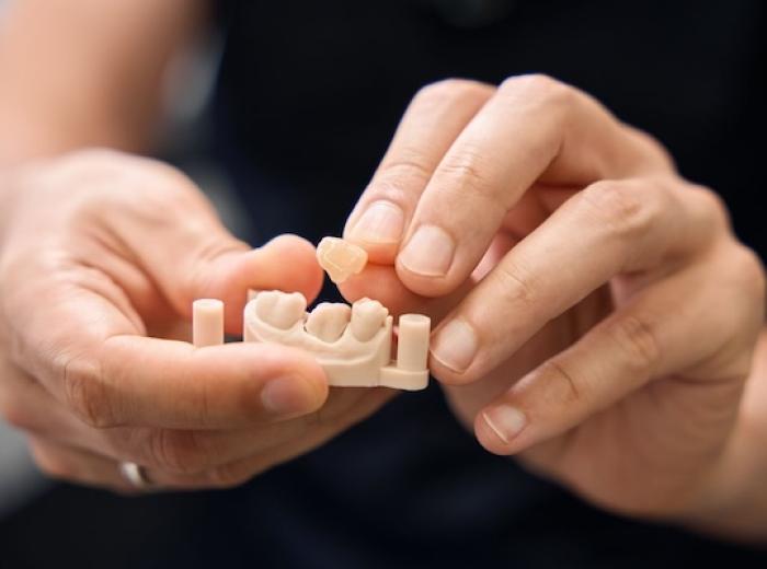 Common Questions About Dental Crowns