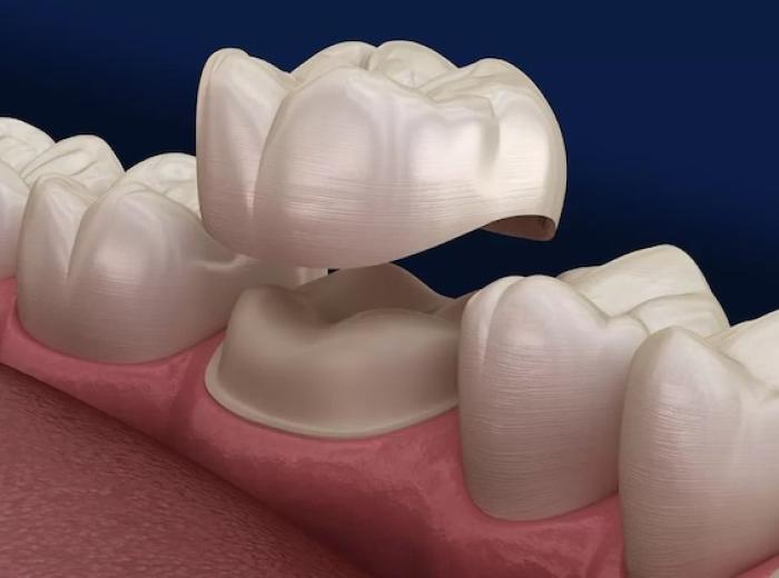 Everything You Need to Know About Dental Crowns