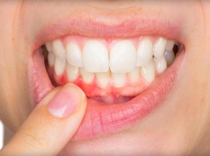 Gum Disease Warning Signs Most People Miss