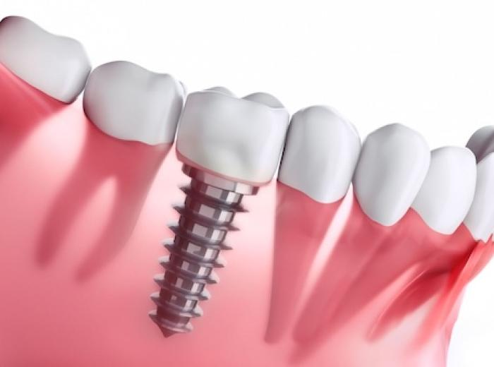 Is a Dental Implant Worth It?