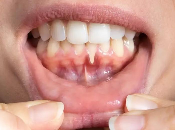 The Importance of Gum Health for Patients