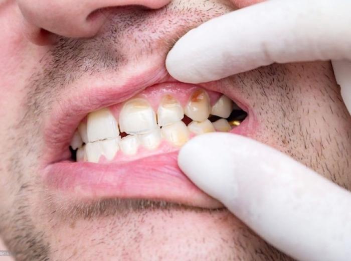 Understanding the Stages of Tooth Decay
