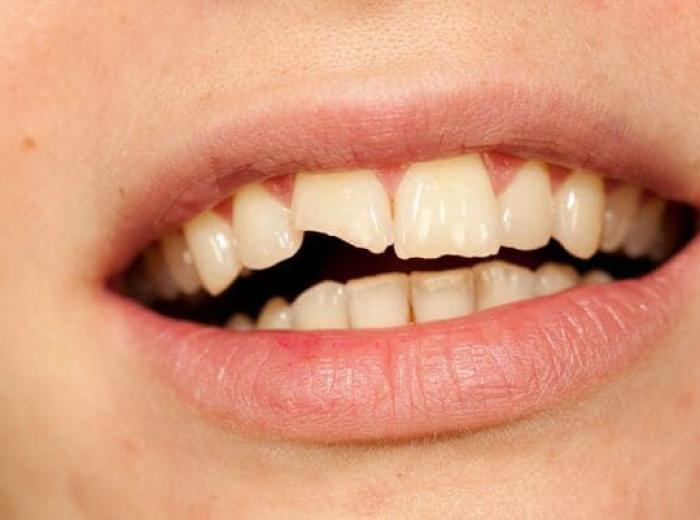 What to Do If You Break a Tooth