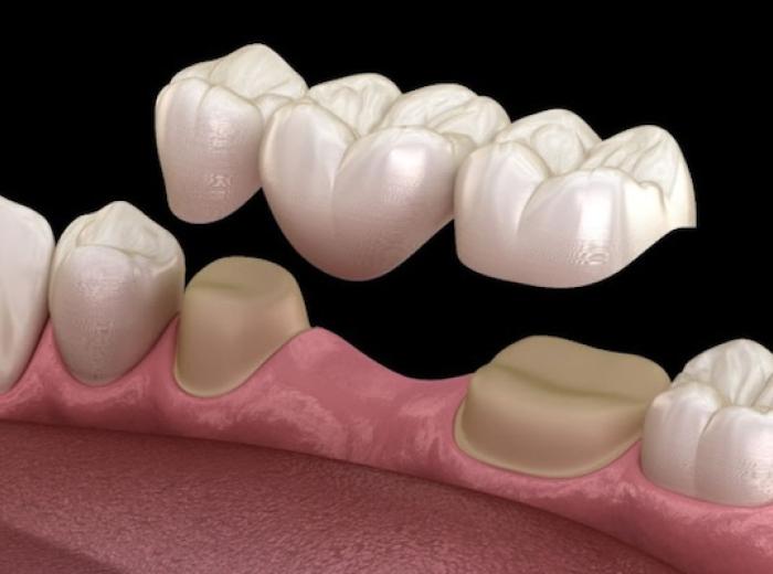 What to Know About Dental Bridges