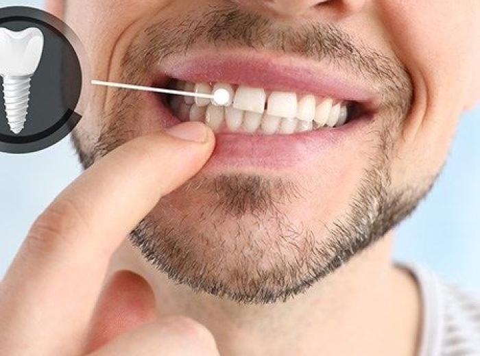 Why Replacing Missing Teeth is Essential