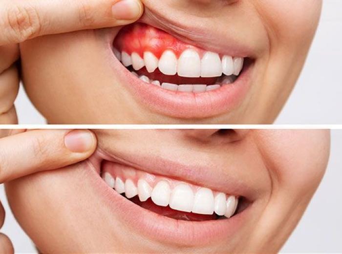 Why You Shouldn’t Ignore Bleeding Gums